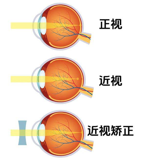 近视是老了不用戴老花镜的“福利”？眼科医生揭秘<strong></p>
<p>老花镜
</strong>！:老花镜
