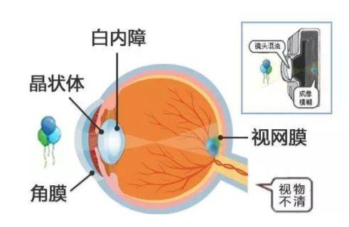 白内障术后老花镜也可以不用戴了吗？:老花镜