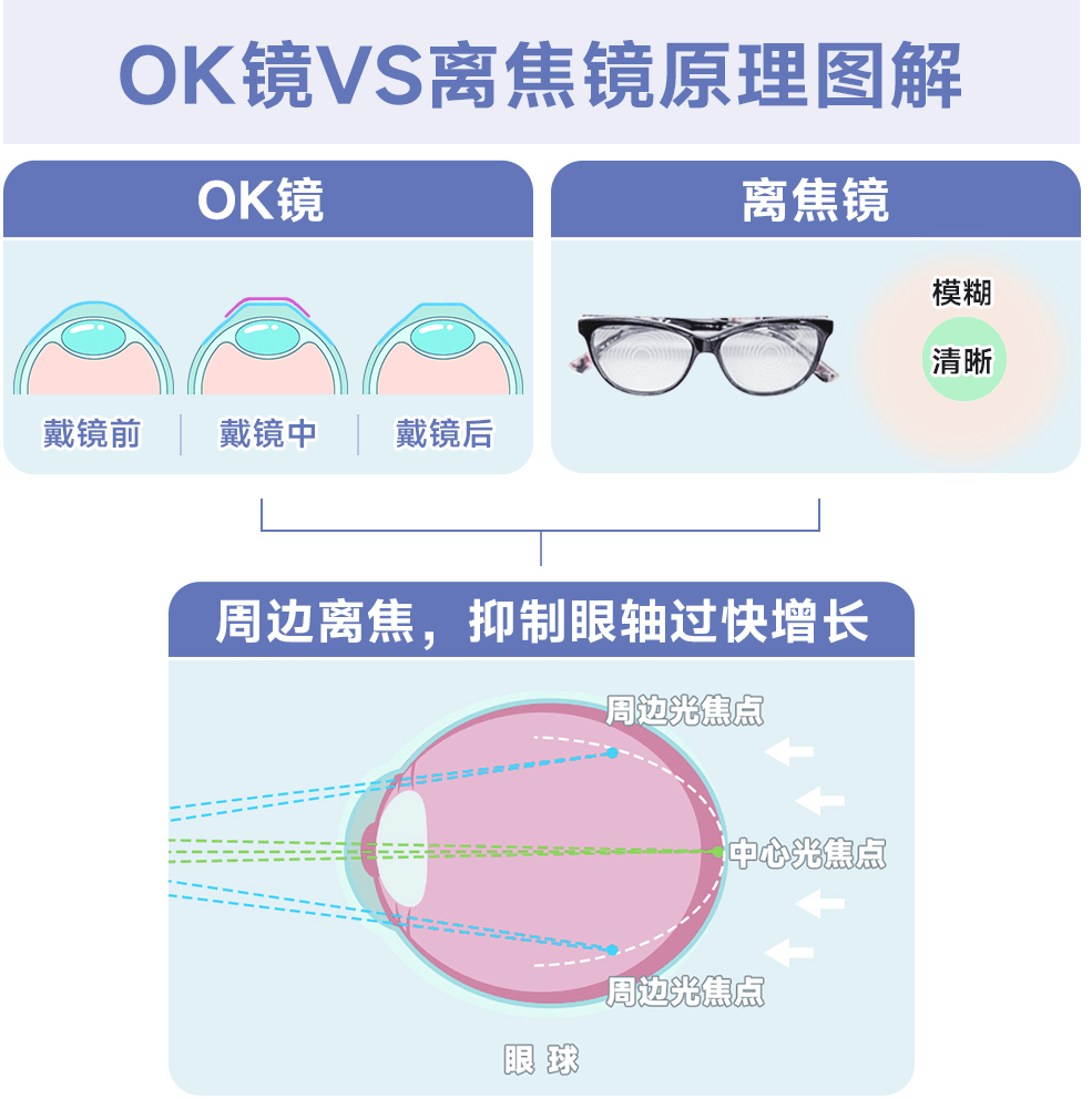 娃近视了！OK镜和离焦镜，到底选哪个？:近视镜