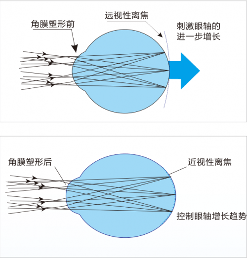 爱成集团仕觉OK镜：近视防控的性价比之选​:近视镜