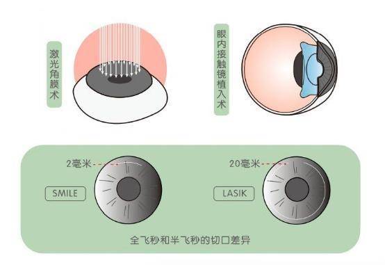 “做完近视手术<strong></p>
<p>近视镜</strong>，以后有你哭的！”摘镜真是不归路吗？无锡近视:近视镜